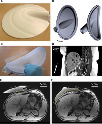 A tailored passive driver for liver MRE in pediatric patients